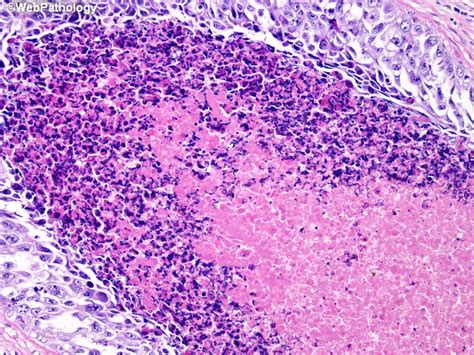 Myofiber necrosis metabolic muscle fiber cytoplasm: Webpathology.com: A Collection of Surgical Pathology Images
