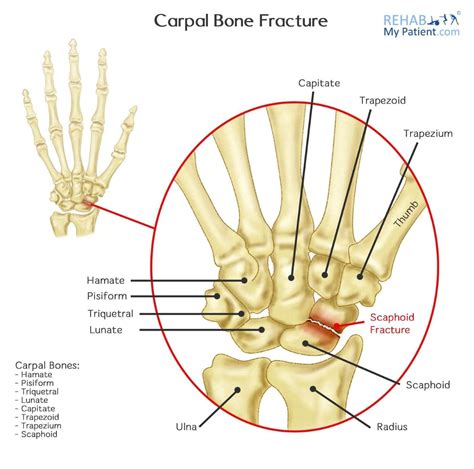 Image Result For Images Of Common Bones Carpels Broken Wrist Anatomy