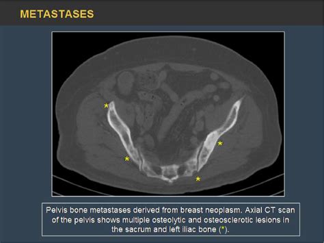 Figure 16 From Pelvic Bone Lesions A Radiologic Pictorial Review
