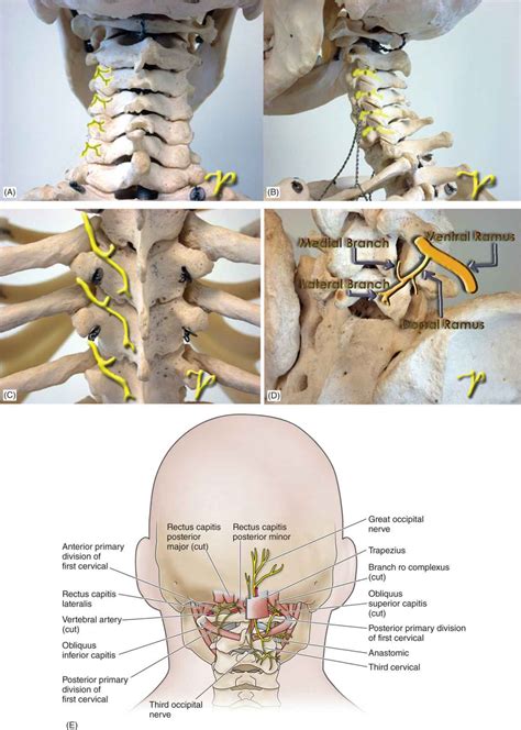 Facet Joint Interventions Intra Articular Injections Medial Branch