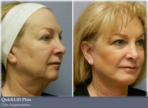 Quick Lift Vargas Face And Skin Center