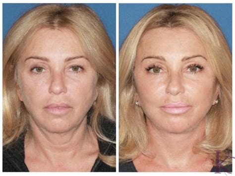 Facelift Case 27 Dr Vasyukevich Facial Plastic Surgeon Nyc