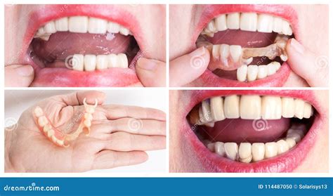 Dental Rehabilitation With Upper And Lower Prosthesis Before And After