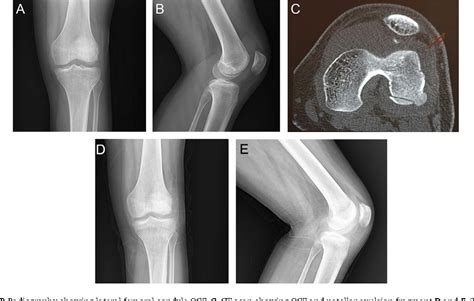 Figure From Osteochondral Fracture In Weight Bearing Portion Of Lateral Femoral Condyle