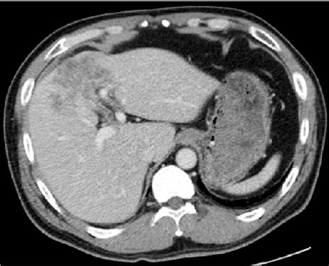 Ct Shows A Large Lobulated Mass 70 Cm × 35 Cm In Segment 4 With