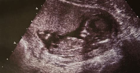 Ultrasounds At The Mall Are Keepsake Ultrasounds Worth The Risk