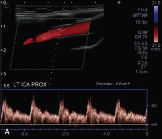 Ultrasound Assessment Of Carotid Stenosis Radiology Key