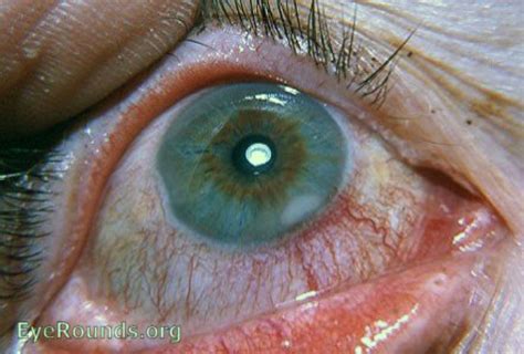 Corneal Marginal Ulcer