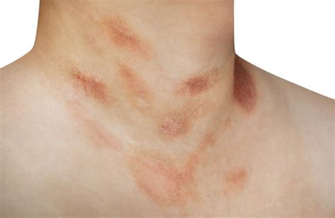 Pityriasis Rosea Archives The Dermatology Center Of Indiana