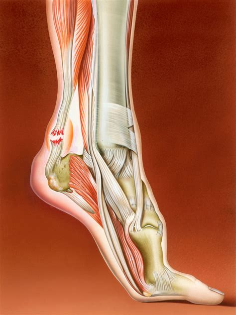 Achilles Tendon Injuries What You Should Know Yeah Livestrong