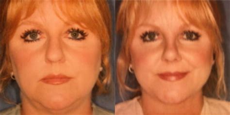 Nose Surgery Before And After Photos Patient 3 San Francisco Ca