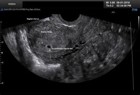 4 weeks pregnant ultrasound health recovery tips