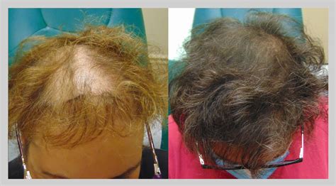 Hair loss treatments available to patients get better and better as time goes on. Exosomes Hair Restoration Therapy - New Jersey - New York ...