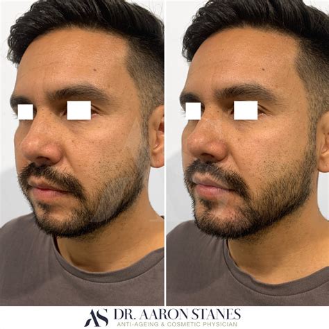 Male Chin Example 10 Dr Aaron Stanes Anti Ageing And Cosmetic Medicine