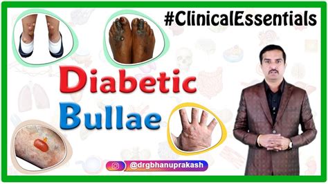 Diabetic Bullae Bullosis Diabeticorum Clinical Essentials Youtube