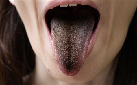 Black Tongue And Alcohol Abuse Causes Symptoms And Treatment