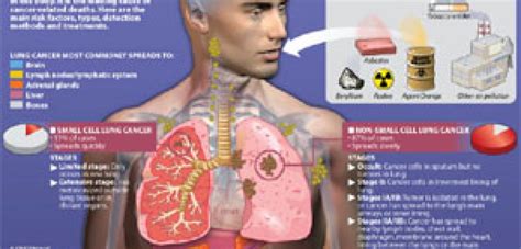 Causes Of Lung Cancer Only Infographic