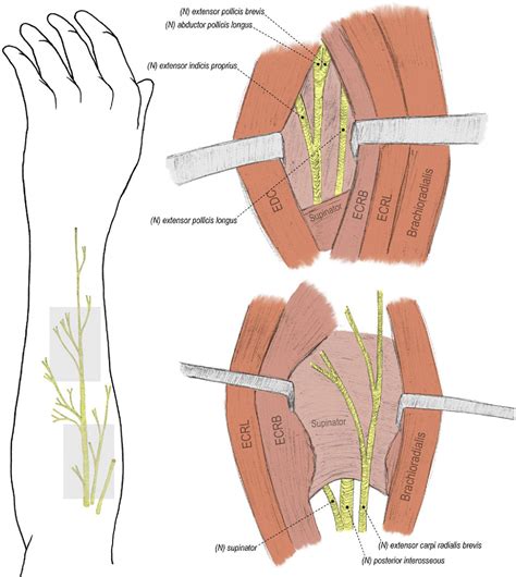 Figure From Direct Radial To Ulnar Nerve Transfer To Restore