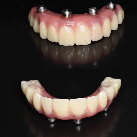 All On 4 Same Day Teeth Also Known As Hybrid Dentures These Are The