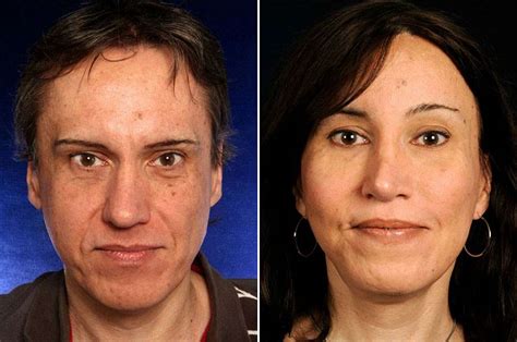 Facial Feminization Surgery Cheek Augmentation Creating High And