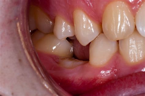 Baby Teeth In Adults Blue Court Dental Centre Harrow