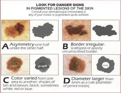 Skin Cancer And Your Feet Next Step Foot And Ankle Clinic