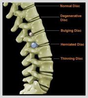 Treatment of a herniated disc is complicated because of the individualized nature of each patient's pain and symptoms. BEST Laser Spine Surgery COST in India| DheerajBojwani.Com