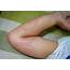 Papular Urticaria In Children  Causes Symptoms And Treatment