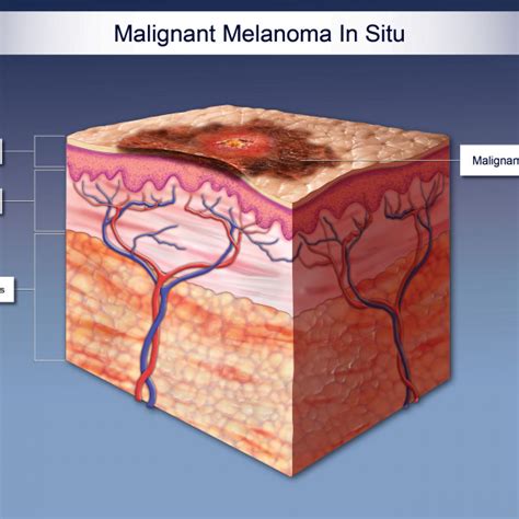 Malignant Melanoma In Situ Trialexhibits Inc