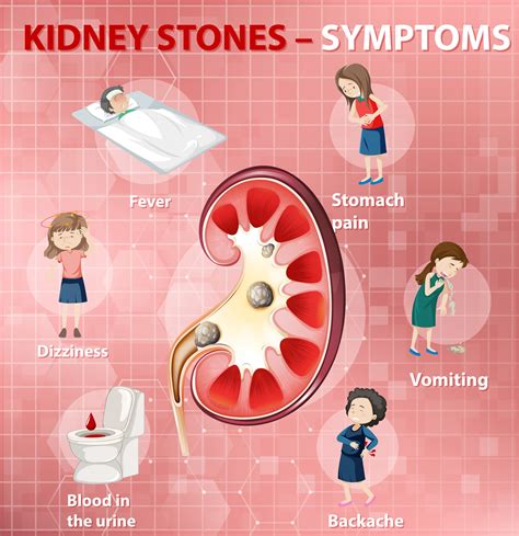 Kidney Stones Causes Symptoms Types And Treatment