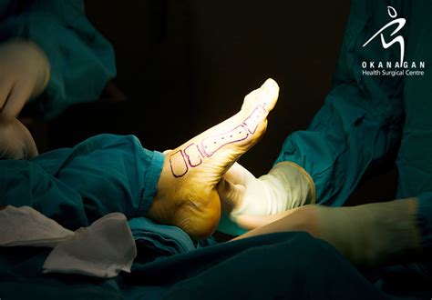 Everything To Know About Foot Fusion Surgery Kelowna General Surgery