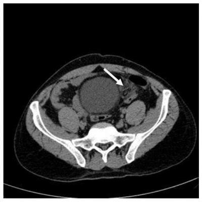 1 3 CT Scan Of Abdomen And Pelvis Without IV Contrast Administration