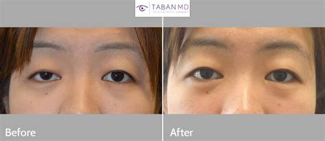 eyelid ptosis before and after gallery taban md