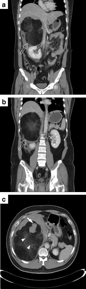 Ct Of Abdomen With Contrast Showed A Huge Retroperitoneal Majorly