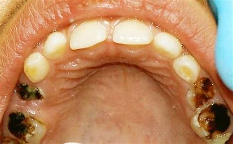 Tooth Abscess Medical Pictures Info Health Definitions Photos