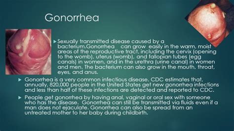 What Is Gonorrhea The Clap Causes Symptoms Treatments Public Health