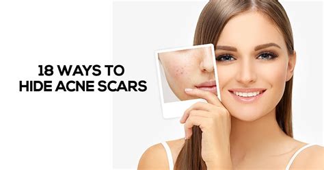 How To Fade Acne Scars