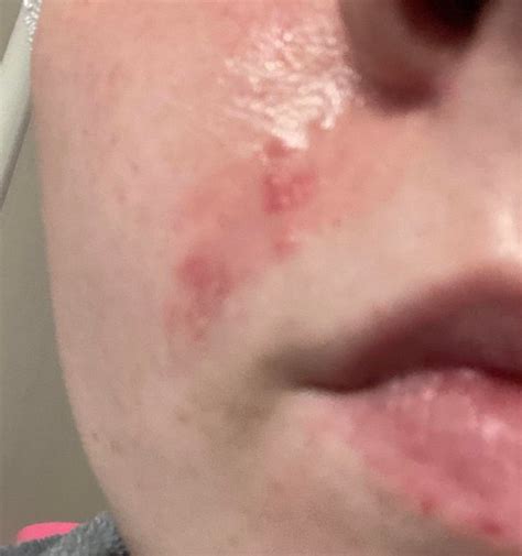 Does Anyone Know What This Rash Is And How To Fix It R