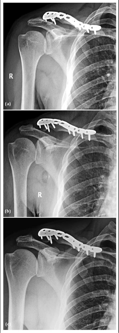Figure 3 From Segmental Clavicle Fracture With Acromioclavicular Joint