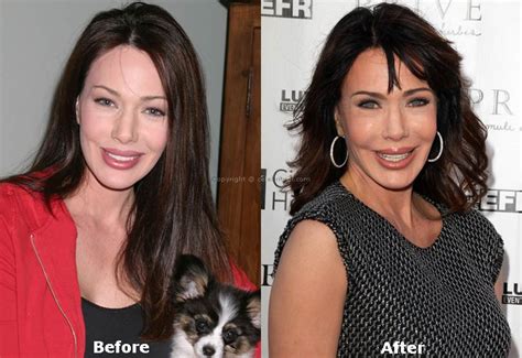 Hunter Tylo Plastic Surgery A Surgical Mistake Celebrity Dr