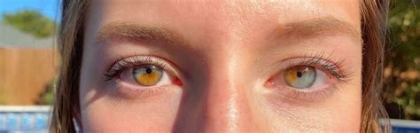 I Have Partial Heterochromia In Both Eyes In 2023 Heterochromia Eyes Different Colored Eyes