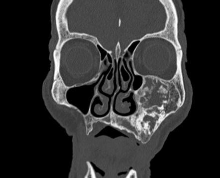 Maxillary Sinus Osseous Mass Radiology Case Radiopaedia Org