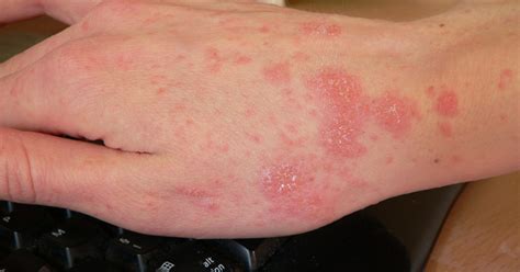Asheville Nursing Home Residents Staff Treated For Scabies