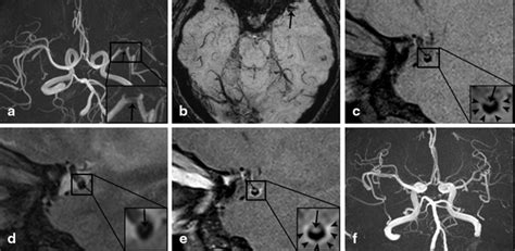 Symptomatic Unruptured Isolated Middle Cerebral Artery Dissection
