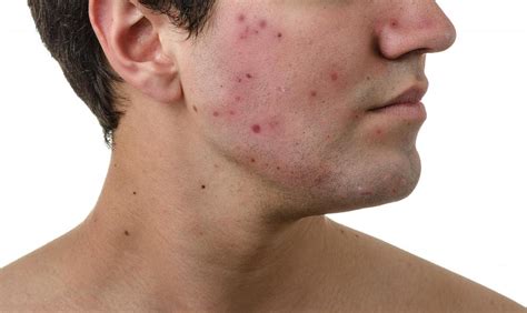 How Do I Choose The Best Severe Acne Treatment With Pictures
