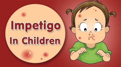 Impetigo In Children Signs Causes And Treatment Youtube
