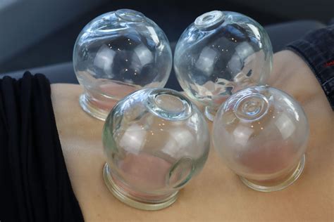 Cupping Therapy In Burnaby Burnaby Physiotherapist