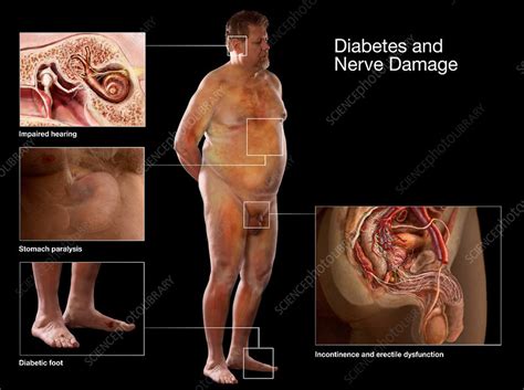 Maybe you would like to learn more about one of these? Diabetes and Nerve Damage - Stock Image - C043/6352 ...