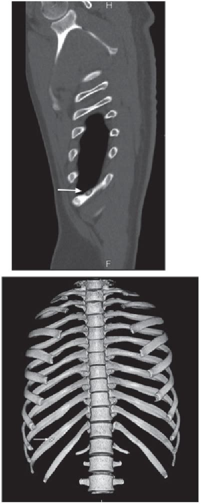Figure 8 From Osteoid Osteoma Of The Rib A Report Of Two Cases