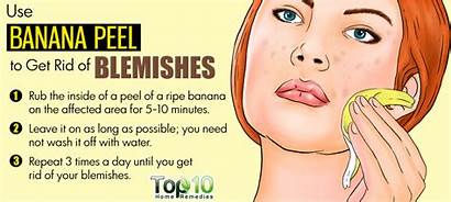 Blemishes Remedies Banana Skin Acne Rid Types